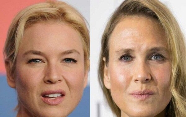 Eyelid Surgery Cost in USA