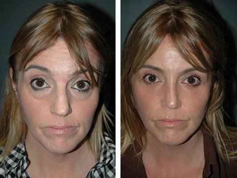 Eyelid Surgery Cost in USA