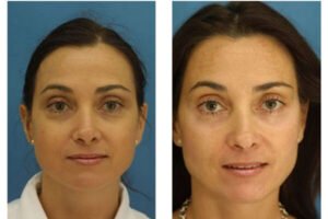 Eyelid Surgery Cost in USA