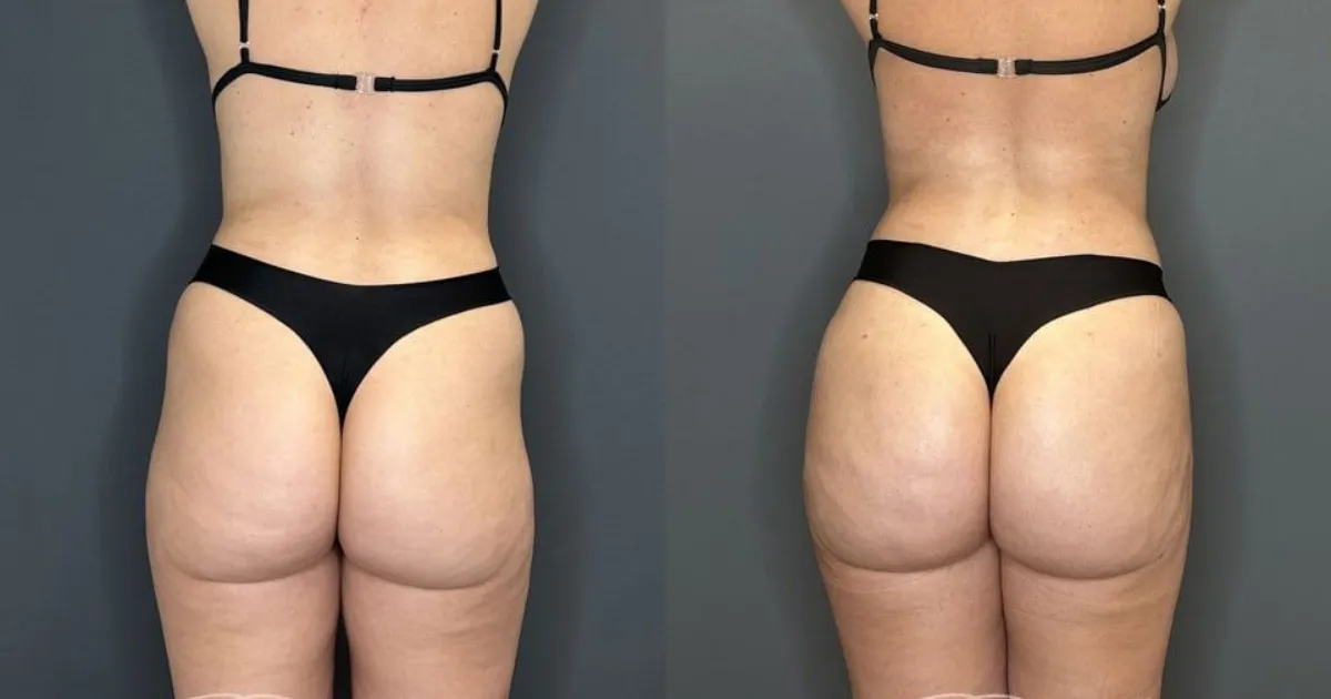 BBL Surgery Cost in USA in 2026