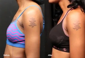 Fat Transfer Breast Augmentation Cost in USA, Average Cost, Inclusions, Insurance & Financing (2026 Guide)