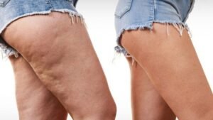 How to Get Rid of Cellulite